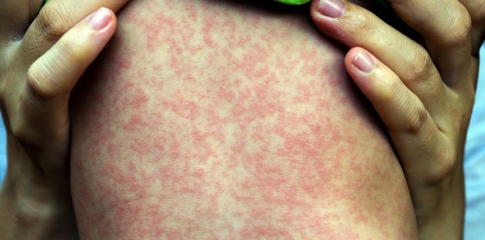 measles-rash-min.jpg